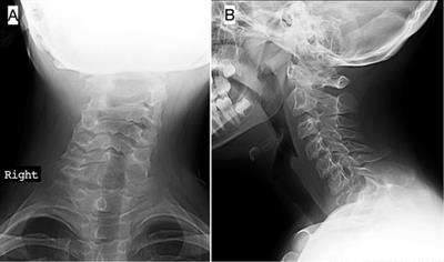 Case Report: Giant cell-rich osteosarcoma of the cervical spine in the pediatric age. A rare entity to consider